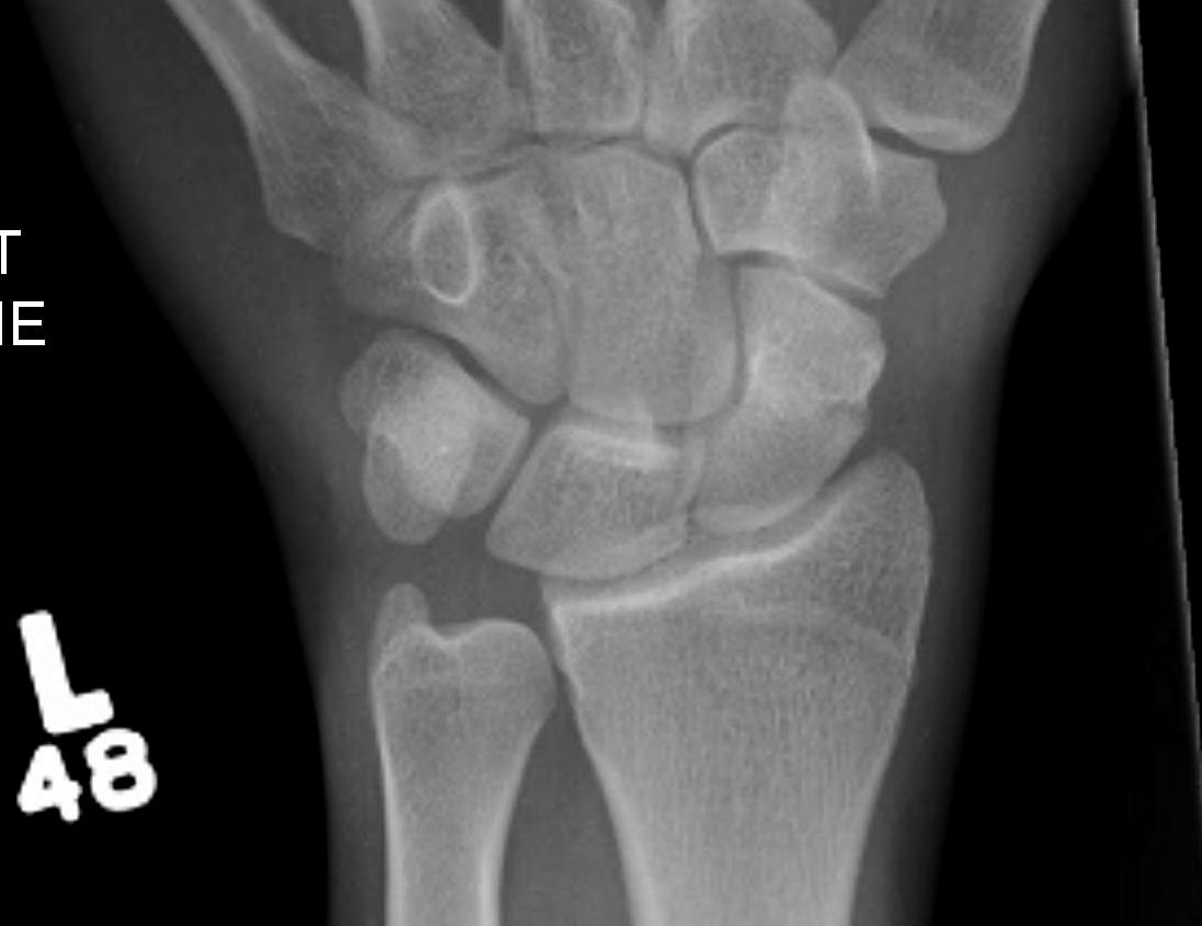 Scaphoid Fracture Incomplete
